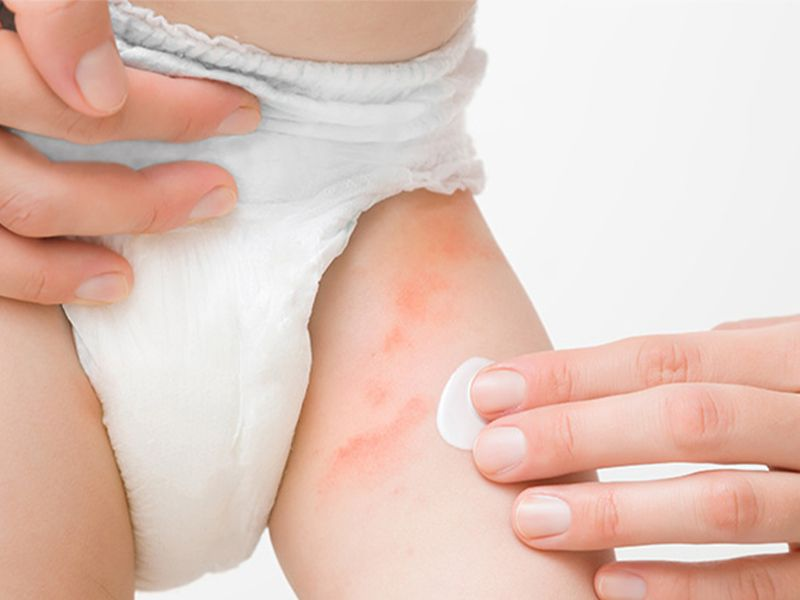 YAZ SICAKLARINDA BEBEK PİŞİKLERİ            ANNE ve BABALAR DİKKAT