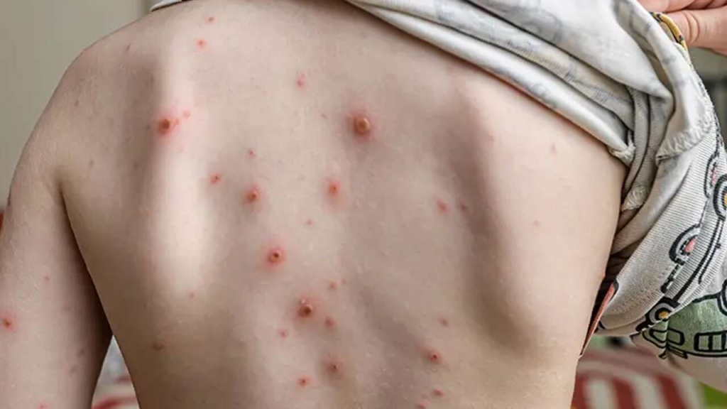 Çocuklarda Suçiçeği Artışı Rekor Seviyede